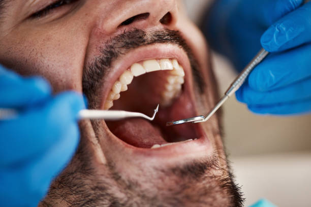 Best Emergency Dental Filling Replacement  in Bolivar, OH